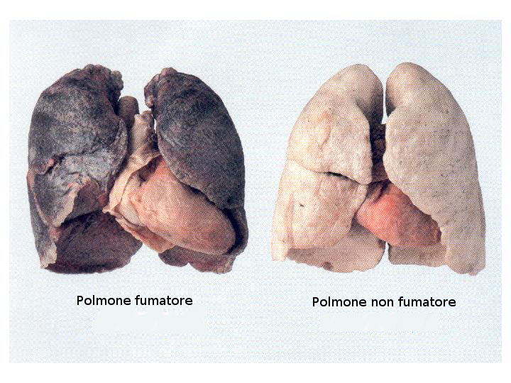 Confronto tra i polmoni di un fumatore e di un non fumatore